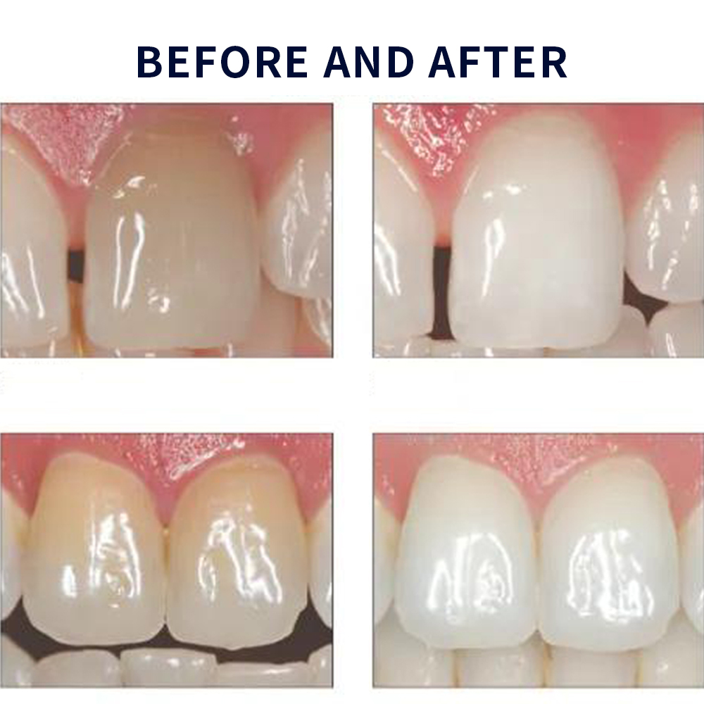 Opalescence Whitening 20% PF 2 – Teeth Whitening Near Me recenzja i cena
