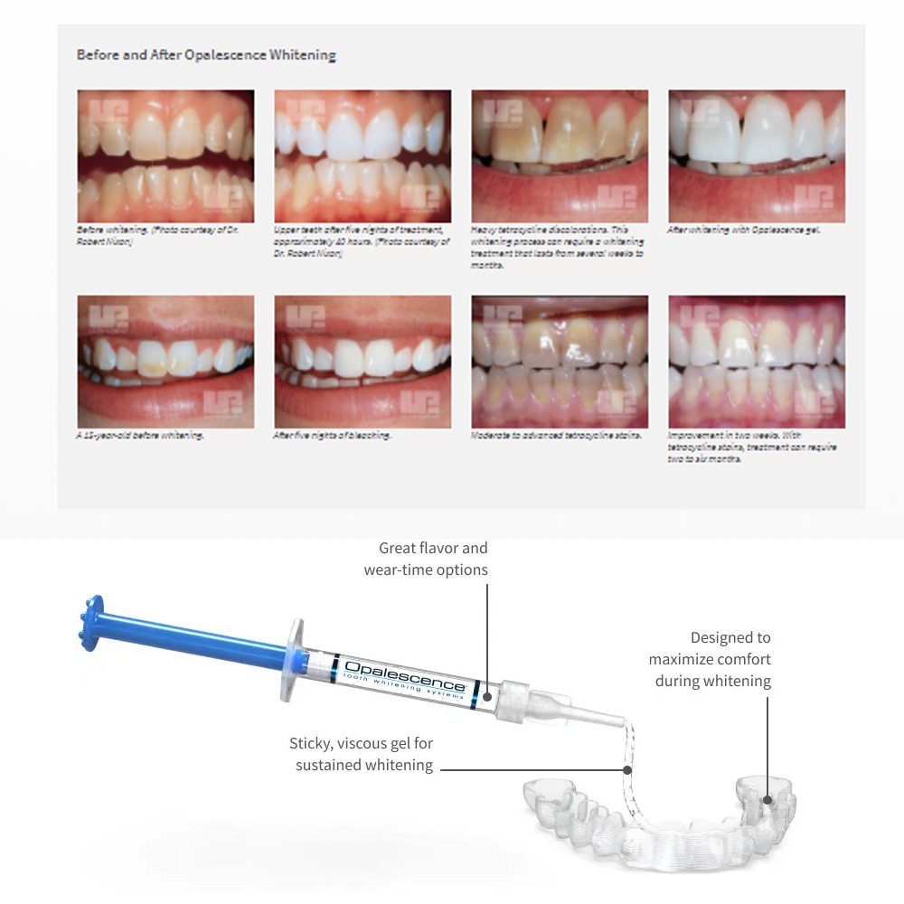 Opalescence Whitening 20% PF 2 – Teeth Whitening Near Me recenzja i cena