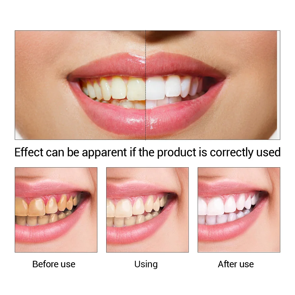 FTEENPLY esencja do wybielania – Teeth Whitening Near Me recenzja i cena