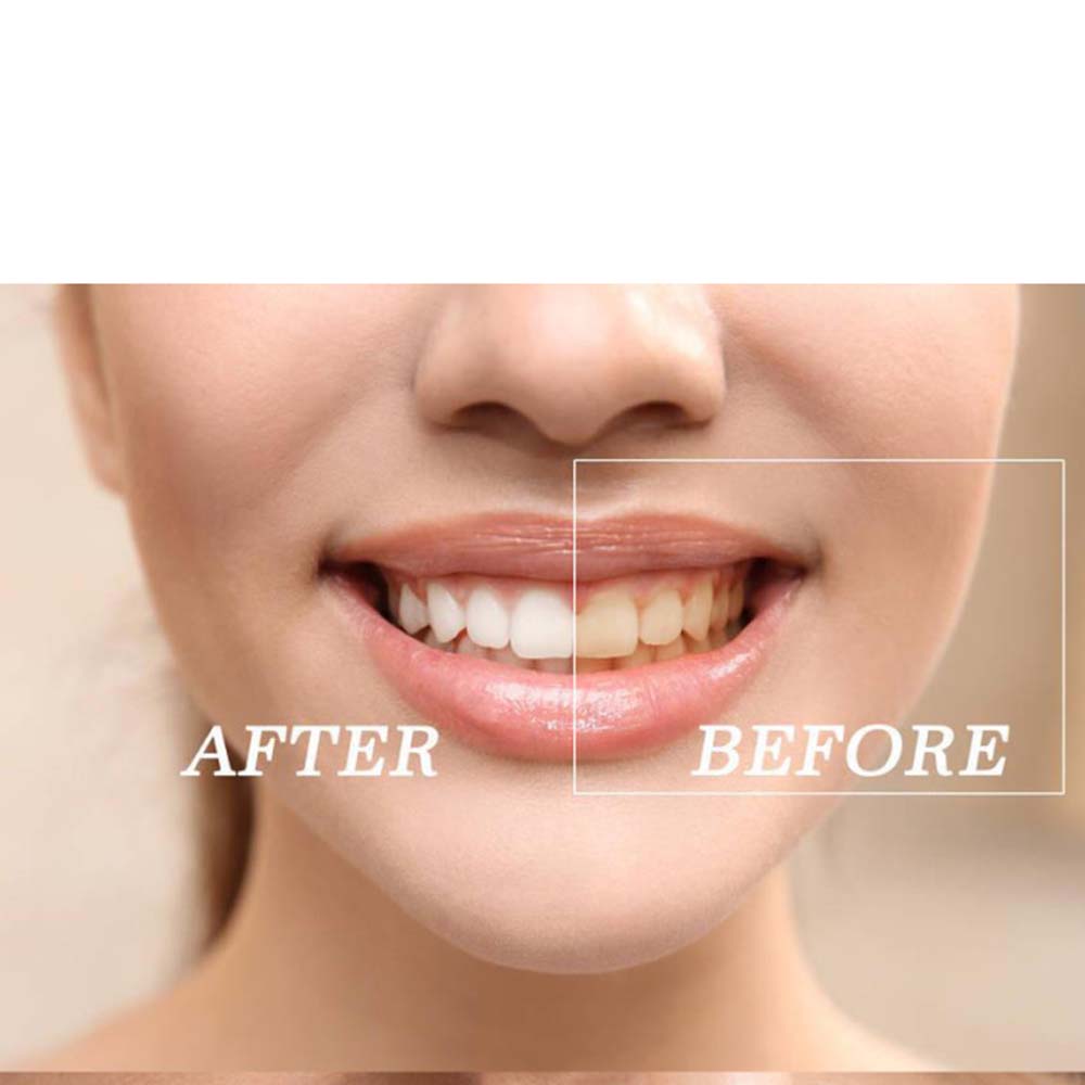 Najwyższej jakości zestaw żelo – Teeth Whitening Kit recenzja i cena
