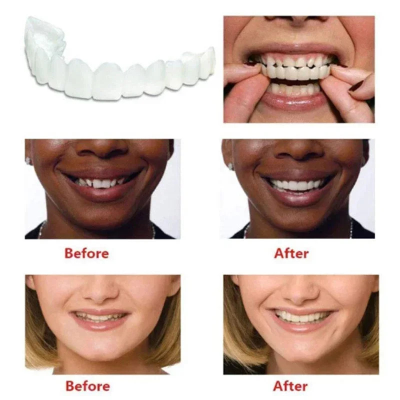 Idealne dopasowanie, wybielają – Teeth Whitening Moulds recenzja i cena