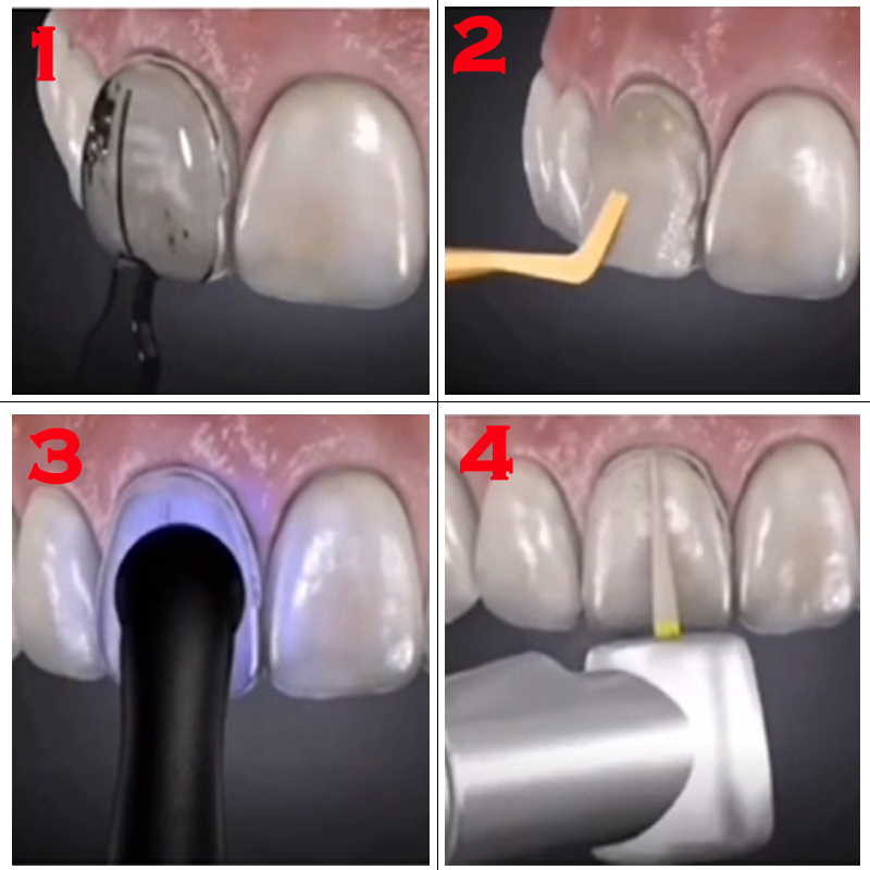 Forma do autoklawowania, przez – Teeth Whitening Moulds recenzja i cena