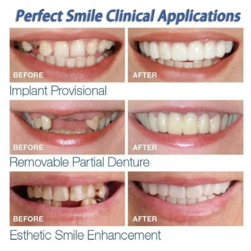 Zestaw zatrzaskowych płyt okła – Teeth Whitening Kit recenzja i cena