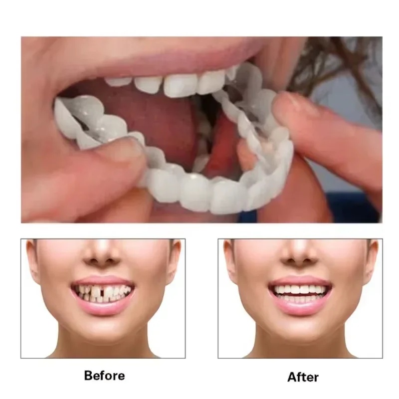 Zestaw zatrzaskowych płyt okła – Teeth Whitening Kit recenzja i cena